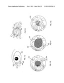 ORTHOVOLTAGE RADIOTHERAPY diagram and image