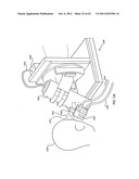 ORTHOVOLTAGE RADIOTHERAPY diagram and image