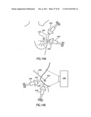 ORTHOVOLTAGE RADIOTHERAPY diagram and image