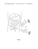 ORTHOVOLTAGE RADIOTHERAPY diagram and image