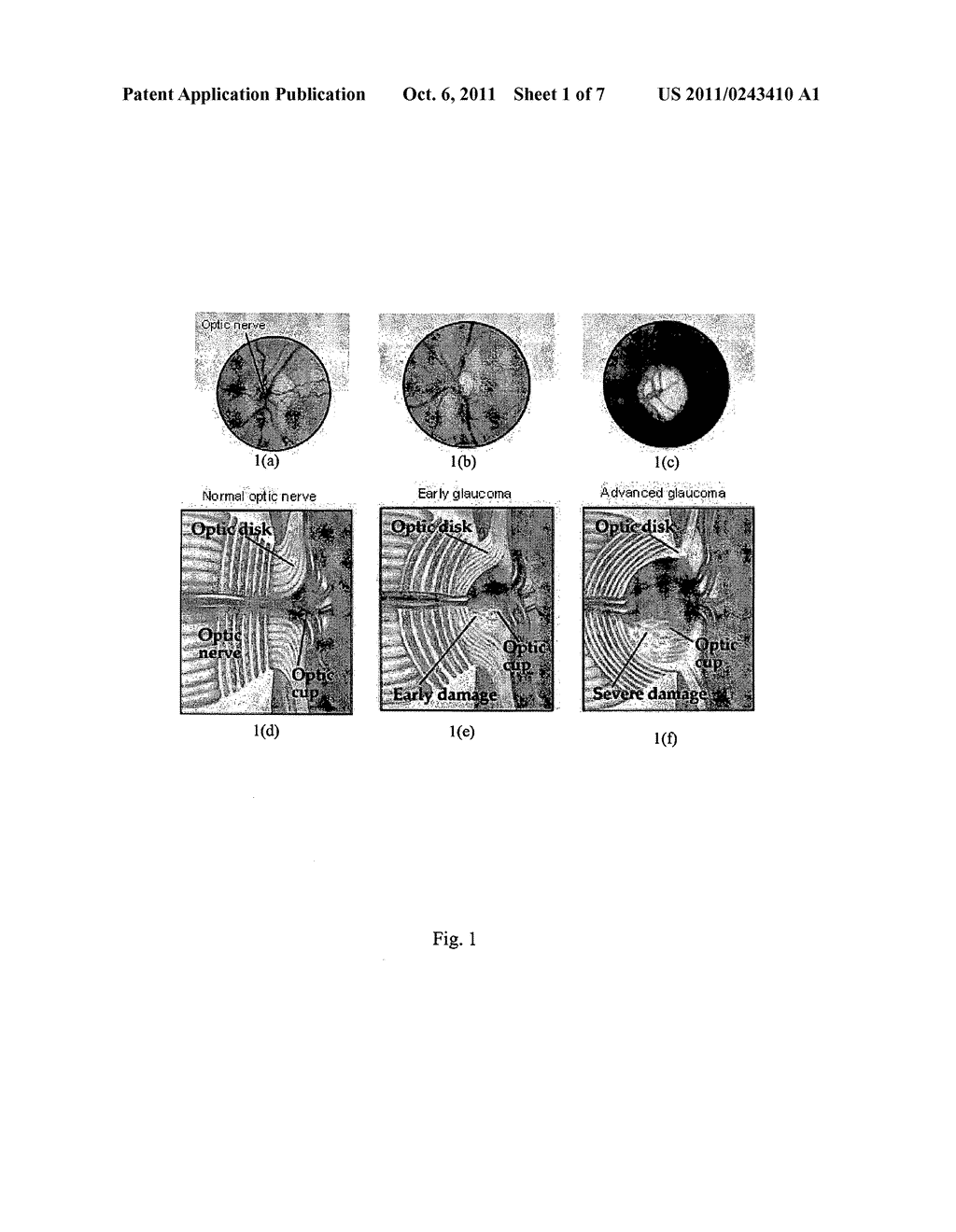 METHOD AND SYSTEM FOR DETERMINING THE POSITION OF AN OPTIC CUP BOUNDARY - diagram, schematic, and image 02