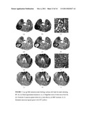 SYSTEM AND METHOD FOR ACCURATE AND RAPID IDENTIFICATION OF DISEASED     REGIONS ON BIOLOGICAL IMAGES WITH APPLICATIONS TO DISEASE DIAGNOSIS AND     PROGNOSIS diagram and image