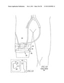 Method and System for Closed Chest Blood Flow Support diagram and image