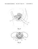 PELVIC IMPLANT WITH ANCHORING FRAME diagram and image