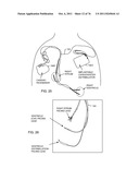 INTEGRATED TANK FILTER FOR A MEDICAL THERAPEUTIC DEVICE diagram and image