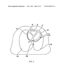 IMPROVED MONITOR OF HEART FAILURE USING BIOIMPEDANCE diagram and image