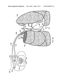 IMPROVED MONITOR OF HEART FAILURE USING BIOIMPEDANCE diagram and image