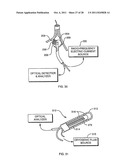 DEFLECTABLE SHEATH CATHETERS diagram and image