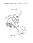 SUTURE PASSER SYSTEMS AND METHODS FOR TONGUE OR OTHER TISSUE SUSPENSION     AND COMPRESSION diagram and image