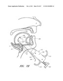 SUTURE PASSER SYSTEMS AND METHODS FOR TONGUE OR OTHER TISSUE SUSPENSION     AND COMPRESSION diagram and image