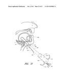 SUTURE PASSER SYSTEMS AND METHODS FOR TONGUE OR OTHER TISSUE SUSPENSION     AND COMPRESSION diagram and image