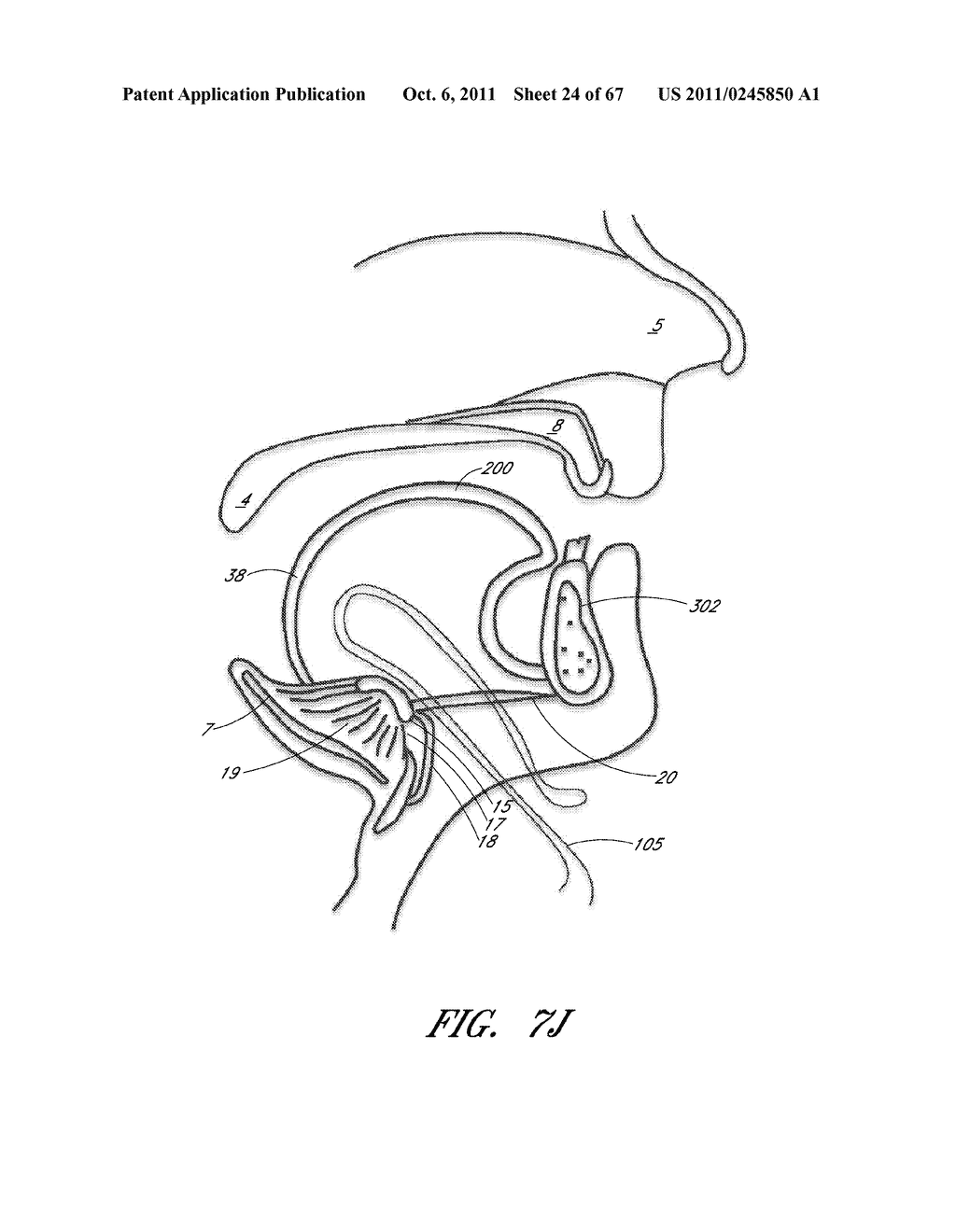 SUTURE PASSER SYSTEMS AND METHODS FOR TONGUE OR OTHER TISSUE SUSPENSION     AND COMPRESSION - diagram, schematic, and image 25