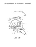 SUTURE PASSER SYSTEMS AND METHODS FOR TONGUE OR OTHER TISSUE SUSPENSION     AND COMPRESSION diagram and image