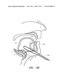 SUTURE PASSER SYSTEMS AND METHODS FOR TONGUE OR OTHER TISSUE SUSPENSION     AND COMPRESSION diagram and image