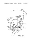 SUTURE PASSER SYSTEMS AND METHODS FOR TONGUE OR OTHER TISSUE SUSPENSION     AND COMPRESSION diagram and image