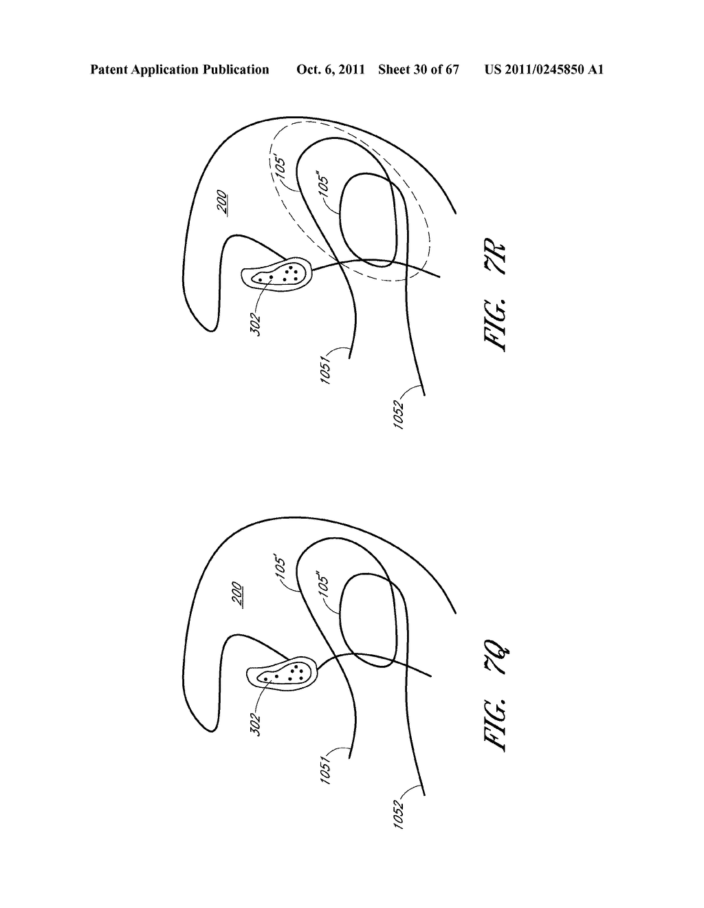 SUTURE PASSER SYSTEMS AND METHODS FOR TONGUE OR OTHER TISSUE SUSPENSION     AND COMPRESSION - diagram, schematic, and image 31