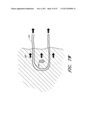 SUTURE PASSER SYSTEMS AND METHODS FOR TONGUE OR OTHER TISSUE SUSPENSION     AND COMPRESSION diagram and image