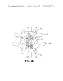 METHOD OF CONNECTING TRANSVERSE BEAM AT TRIANGULAR POSITION OF VERTEBRAL     LAMINA diagram and image