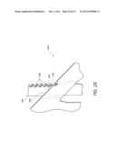 EXPANDABLE SLIDE AND LOCK STENT diagram and image