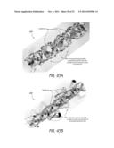 EXPANDABLE SLIDE AND LOCK STENT diagram and image