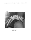 EXPANDABLE SLIDE AND LOCK STENT diagram and image