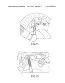 ASSISTED DENTAL IMPLANT TREATMENT AND REPLICATION SYSTEM diagram and image