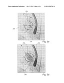 AUTOMATIC ROAD MAPPING FOR HEART VALVE REPLACEMENT diagram and image