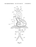 AUTOMATIC ROAD MAPPING FOR HEART VALVE REPLACEMENT diagram and image