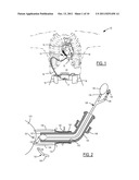 Method and Device for Attachment of an Inflow Conduit to the Heart and to     a Pump diagram and image