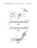 Method and Device for Attachment of an Inflow Conduit to the Heart and to     a Pump diagram and image