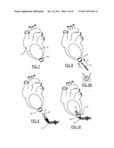 Method and Device for Attachment of an Inflow Conduit to the Heart and to     a Pump diagram and image