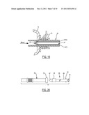 Method and Device for Attachment of an Inflow Conduit to the Heart and to     a Pump diagram and image