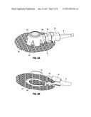 IMPLANTABLE COUPLING DEVICE diagram and image