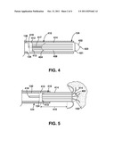 Slidable Fixation Device for  Securing a Medical Implant diagram and image