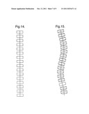 STENT SUITABLE FOR DEPLOYMENT IN A BLOOD VESSEL diagram and image