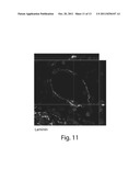 TREATMENT OF BRAIN DAMAGE USING UMBILICAL CORD BLOOD CELLS diagram and image