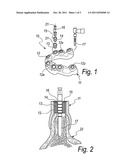 Apparatus for providing implantation sites to be provided in dental     surgery, and a method to be performed with such apparatus diagram and image