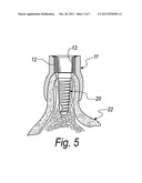 Apparatus for providing implantation sites to be provided in dental     surgery, and a method to be performed with such apparatus diagram and image