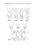 VENTRICULAR FUNCTION ASSISTING DEVICE AND A METHOD AND APPARATUS FOR     IMPLANTING IT diagram and image