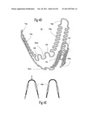 VENTRICULAR FUNCTION ASSISTING DEVICE AND A METHOD AND APPARATUS FOR     IMPLANTING IT diagram and image