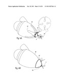 VENTRICULAR FUNCTION ASSISTING DEVICE AND A METHOD AND APPARATUS FOR     IMPLANTING IT diagram and image