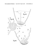 VENTRICULAR FUNCTION ASSISTING DEVICE AND A METHOD AND APPARATUS FOR     IMPLANTING IT diagram and image