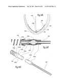 VENTRICULAR FUNCTION ASSISTING DEVICE AND A METHOD AND APPARATUS FOR     IMPLANTING IT diagram and image