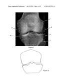 MORPHOMETRY OF THE HUMAN KNEE JOINT AND PREDICTION FOR OSTEOARTHRITIS diagram and image