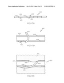 Filament Implant System and Method diagram and image