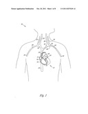 CORONARY SINUS LEAD DELIVERY CATHETER diagram and image