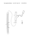 SYSTEMS AND METHODS FOR TREATING A HOLLOW ANATOMICAL STRUCTURE diagram and image