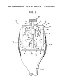 METHOD AND APPARATUS FOR FEMORAL RESECTION ALIGNMENT diagram and image