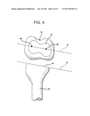 METHOD AND APPARATUS FOR FEMORAL RESECTION ALIGNMENT diagram and image