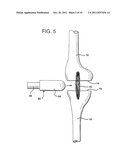 METHOD AND APPARATUS FOR FEMORAL RESECTION ALIGNMENT diagram and image